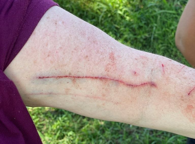 A long red scratch runs across a woman's forearm, with smaller abrasions and redness visible around it. The photograph shows one of the injuries Kari suffered while scrambling away from the runaway boat.